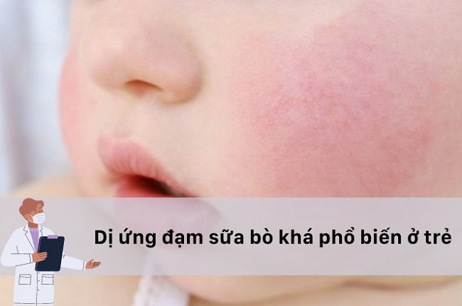 Sữa cho trẻ dị ứng đạm sữa bò